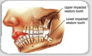 impacted wisdom tooth extraction